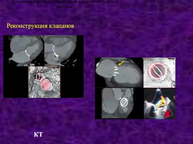 Лучевая диагностика заболеваний сердечно-сосудистой системы Реконструкция клапанов КТ