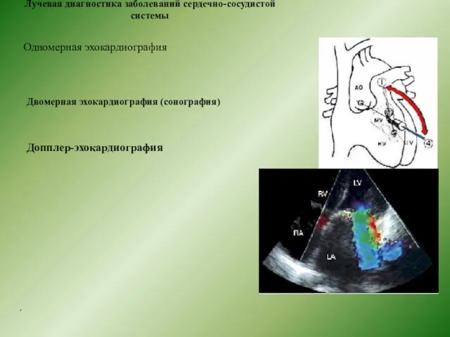 Лучевая диагностика заболеваний сердечно-сосудистой системы Одномерная эхокардиография Двомерная эхокардиография (сонография) Допплер-эхокардиография .