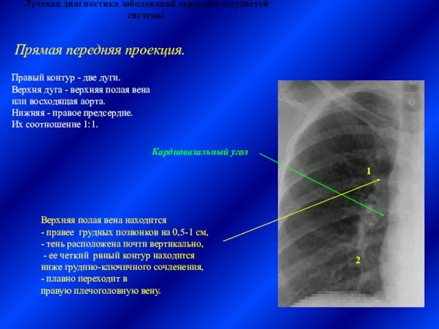 Лучевая диагностика заболеваний сердечно-сосудистой системы Правый контур - две дуги.