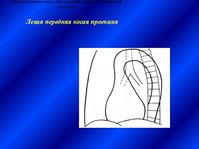 Лучевая диагностика заболеваний сердечно-сосудистой системы Левая передняя косая проекция