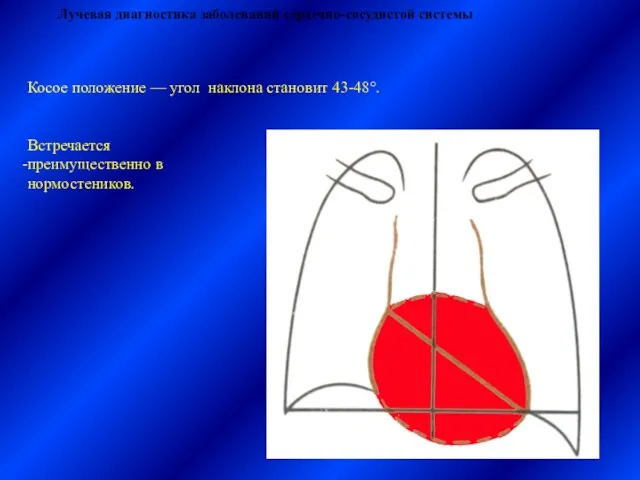 Лучевая диагностика заболеваний сердечно-сосудистой системы Косое положение — угол наклона становит 43-48°. Встречается преимущественно в нормостеников.