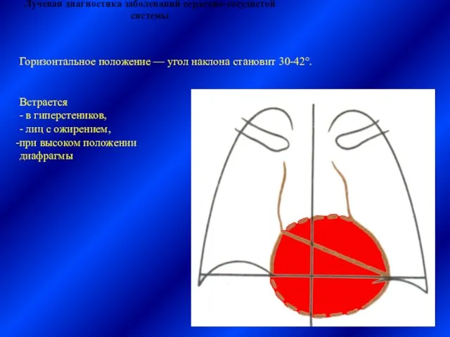 Лучевая диагностика заболеваний сердечно-сосудистой системы Горизонтальное положение — угол наклона