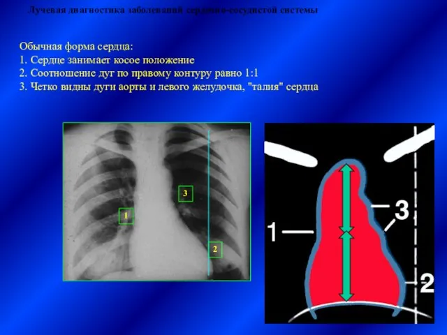 Лучевая диагностика заболеваний сердечно-сосудистой системы Обычная форма сердца: 1. Сердце