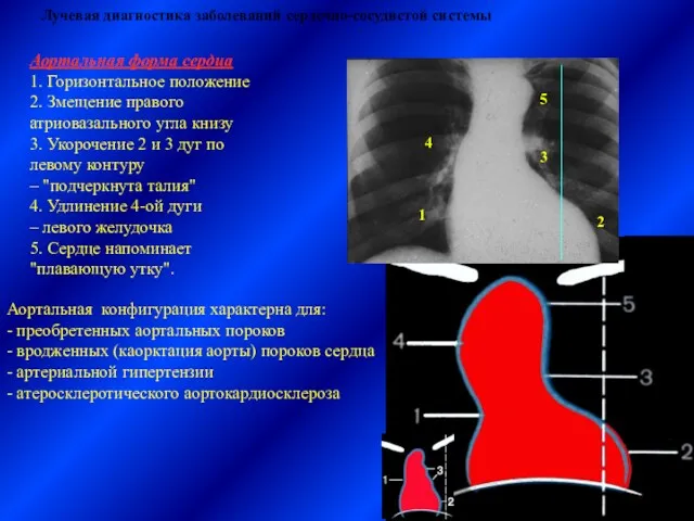 Лучевая диагностика заболеваний сердечно-сосудистой системы Аортальная форма сердца 1. Горизонтальное