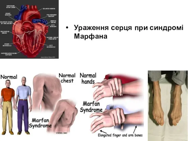 Ураження серця при синдромі Марфана