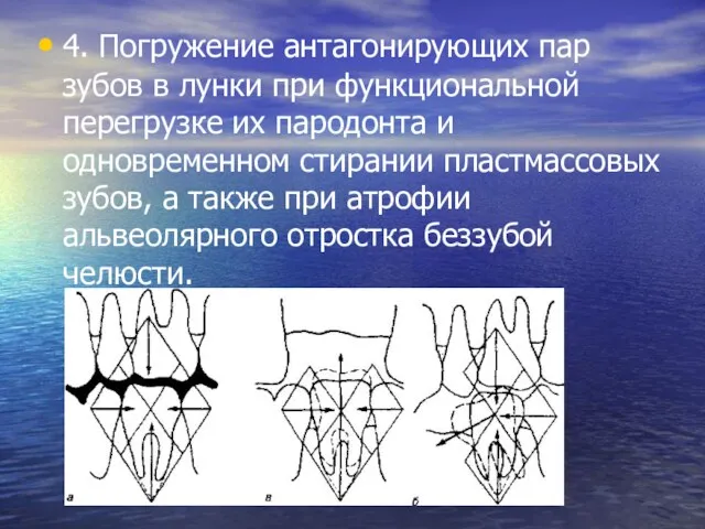 4. Погружение антагонирующих пар зубов в лунки при функциональной перегрузке