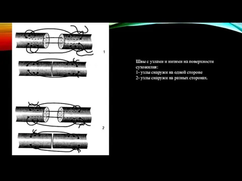 Швы с узлами и нитями на поверхности сухожилия: 1- узлы