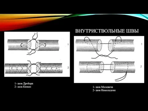 ВНУТРИСТВОЛЬНЫЕ ШВЫ 1- шов Дройера 2- шов Кюнео 1- шов Малевича 2- шов Николадони