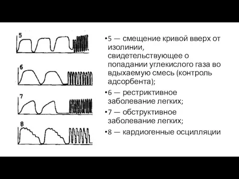 5 — смещение кривой вверх от изолинии, свидетельствующее о попадании углекислого газа во