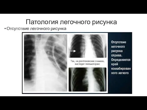 Патология легочного рисунка Отсутствие легочного рисунка