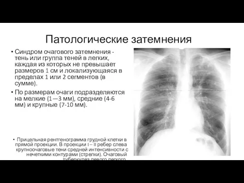 Патологические затемнения Синдром очагового затемнения - тень или группа теней в легких, каждая