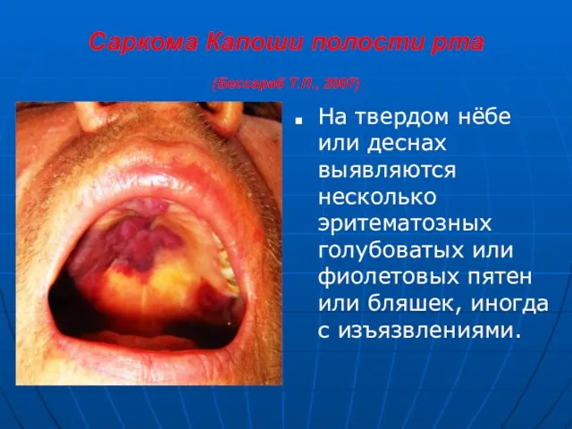 Саркома Капоши полости рта (Бессараб Т.П., 2007) На твердом нёбе или деснах выявляются