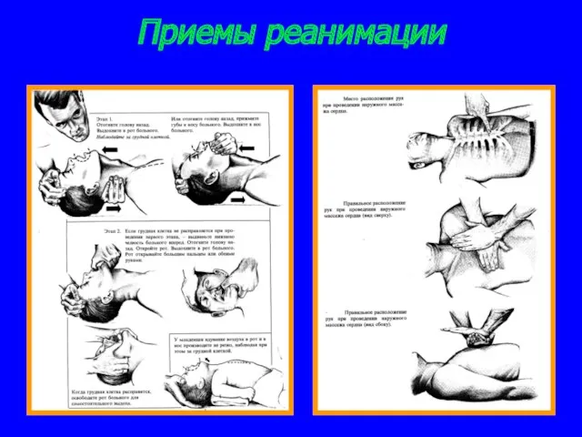 Приемы реанимации