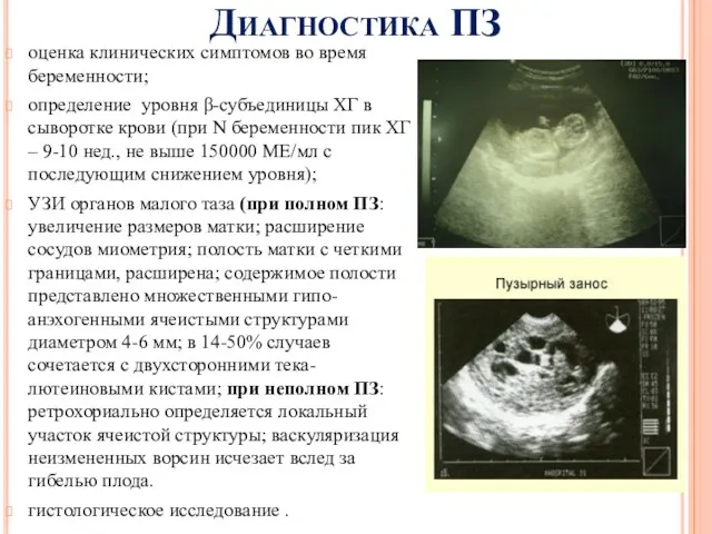 Диагностика ПЗ оценка клинических симптомов во время беременности; определение уровня β-субъединицы ХГ в