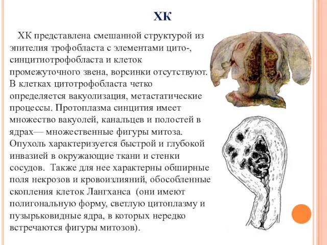 ХК ХК представлена смешанной структурой из эпителия трофобласта с элементами