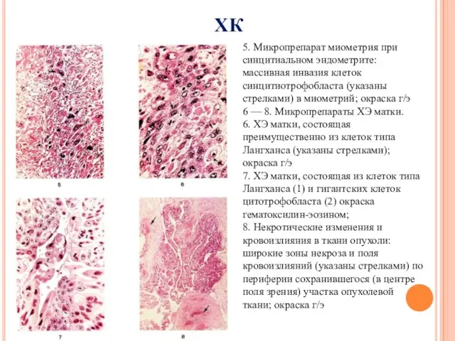ХК 5. Микропрепарат миометрия при синцитиальном эндометрите: массивная инвазия клеток синцитиотрофобласта (указаны стрелками)