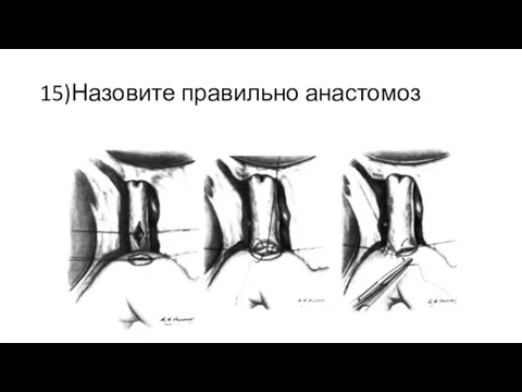 15)Назовите правильно анастомоз