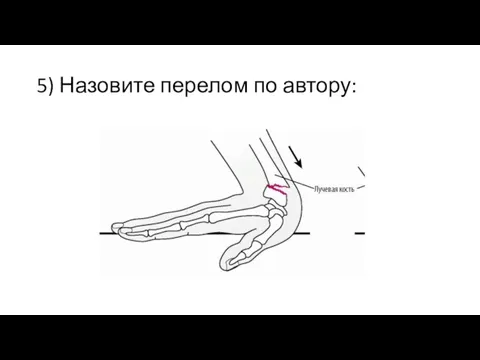 5) Назовите перелом по автору: