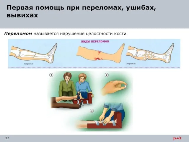 Первая помощь при переломах, ушибах, вывихах Переломом называется нарушение целостности кости.