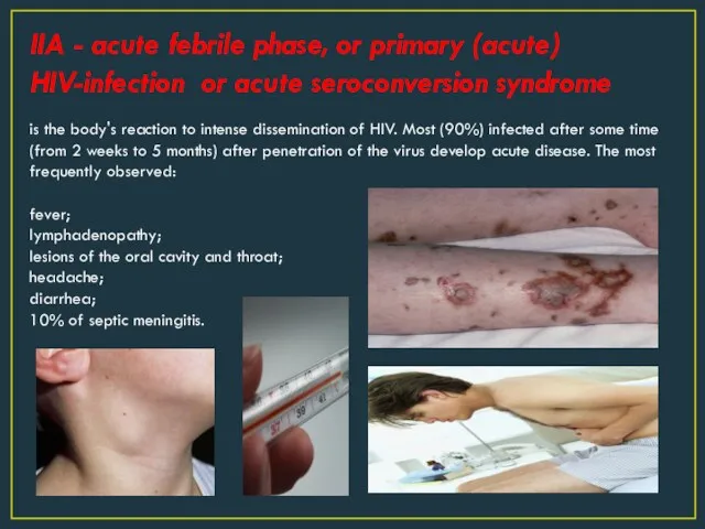 IIA - acute febrile phase, or primary (acute) HIV-infection or acute seroconversion syndrome