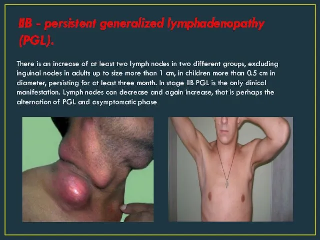 IIB - persistent generalized lymphadenopathy (PGL). There is an increase of at least