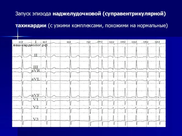 Запуск эпизода наджелудочковой (суправентрикулярной) тахикардии (с узкими комплексами, похожими на нормальные)