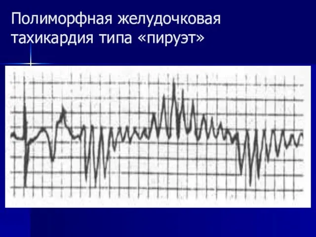 Полиморфная желудочковая тахикардия типа «пируэт»