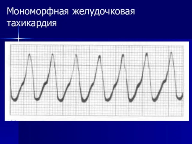 Мономорфная желудочковая тахикардия