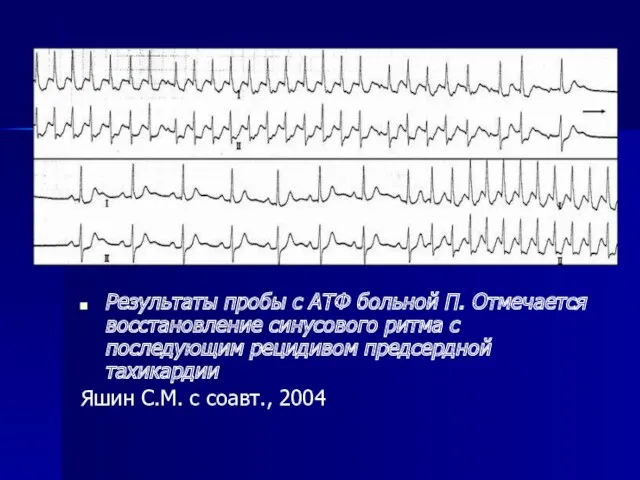 Результаты пробы с АТФ больной П. Отмечается восстановление синусового ритма с последующим рецидивом