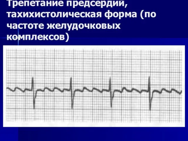 Трепетание предсердий, тахихистолическая форма (по частоте желудочковых комплексов)