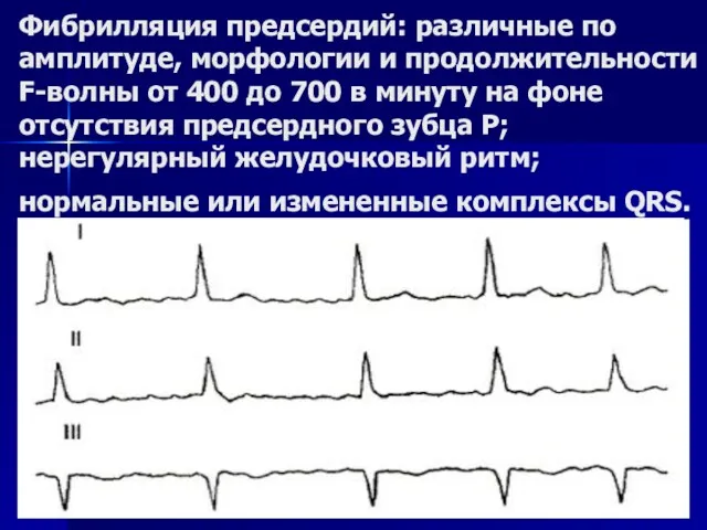 Фибрилляция предсердий: различные по амплитуде, морфологии и продолжительности F-волны от 400 до 700