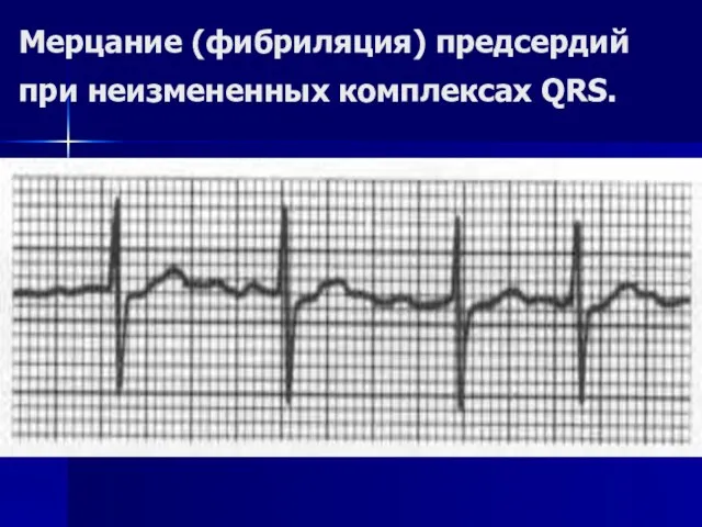 Мерцание (фибриляция) предсердий при неизмененных комплексах QRS.