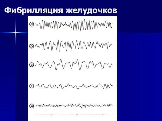 Фибрилляция желудочков