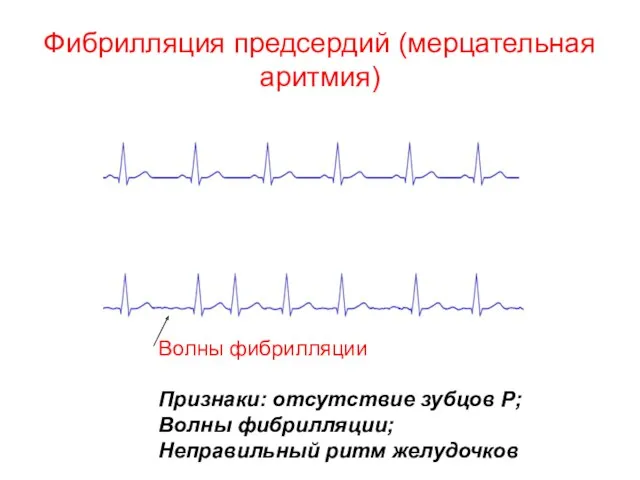 Фибрилляция предсердий (мерцательная аритмия) Волны фибрилляции Признаки: отсутствие зубцов Р; Волны фибрилляции; Неправильный ритм желудочков