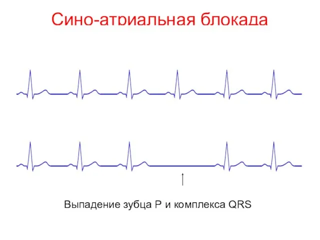 Сино-атриальная блокада Увеличение PQ Выпадение зубца Р и комплекса QRS