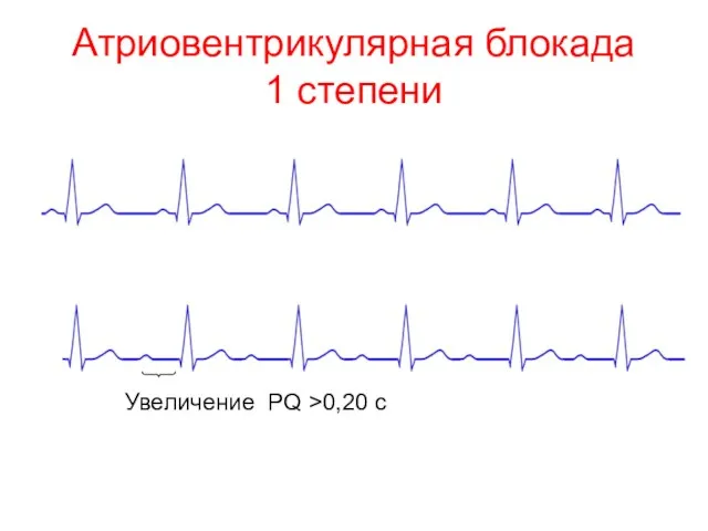 Атриовентрикулярная блокада 1 степени Увеличение PQ >0,20 с