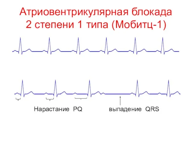 Атриовентрикулярная блокада 2 степени 1 типа (Мобитц-1) Нарастание PQ выпадение QRS