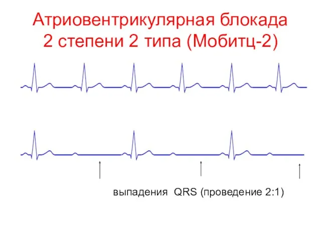 Атриовентрикулярная блокада 2 степени 2 типа (Мобитц-2) выпадения QRS (проведение 2:1)