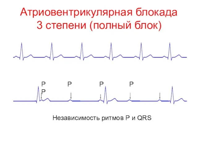 Атриовентрикулярная блокада 3 степени (полный блок) Независимость ритмов Р и QRS Р Р Р Р Р