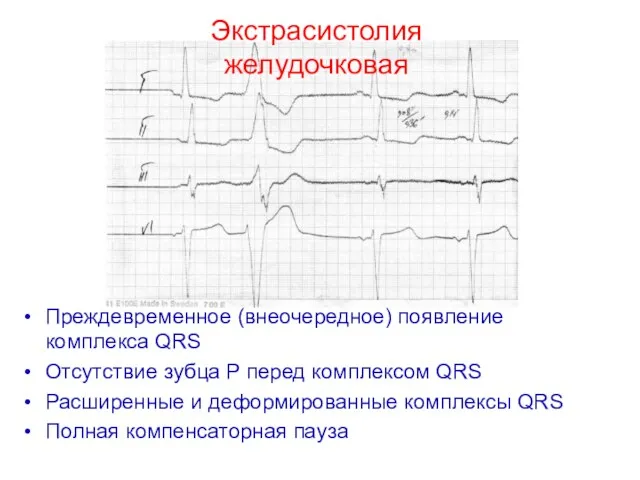 Экстрасистолия желудочковая Преждевременное (внеочередное) появление комплекса QRS Отсутствие зубца Р