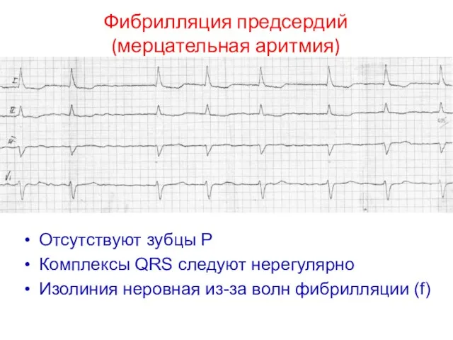 Отсутствуют зубцы Р Комплексы QRS следуют нерегулярно Изолиния неровная из-за