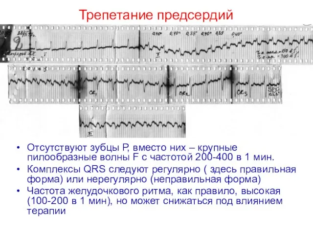 Отсутствуют зубцы Р, вместо них – крупные пилообразные волны F