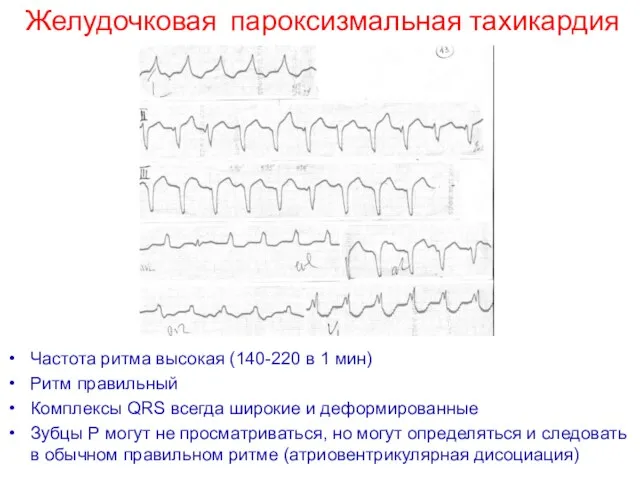 Частота ритма высокая (140-220 в 1 мин) Ритм правильный Комплексы