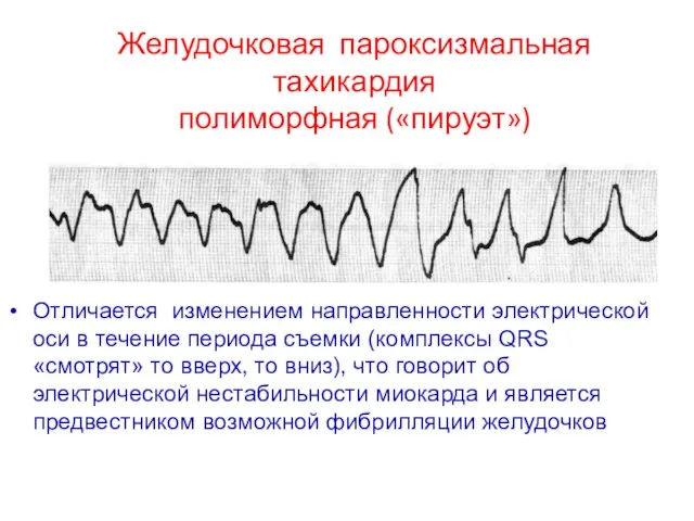 Отличается изменением направленности электрической оси в течение периода съемки (комплексы