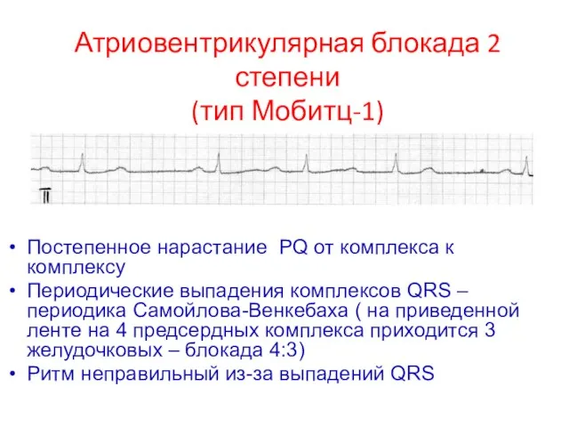 Постепенное нарастание PQ от комплекса к комплексу Периодические выпадения комплексов