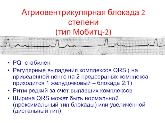 PQ стабилен Регулярные выпадения комплексов QRS ( на приведенной ленте