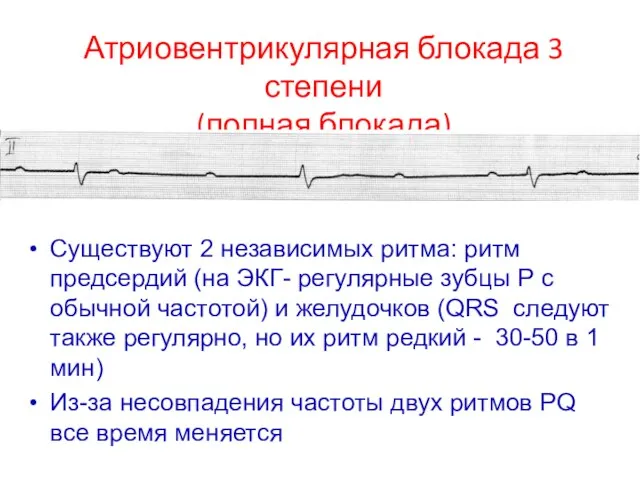 Существуют 2 независимых ритма: ритм предсердий (на ЭКГ- регулярные зубцы