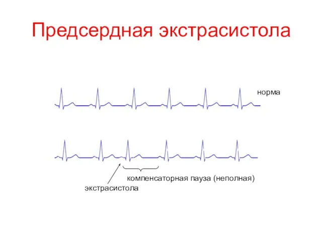 Предсердная экстрасистола компенсаторная пауза (неполная) экстрасистола норма