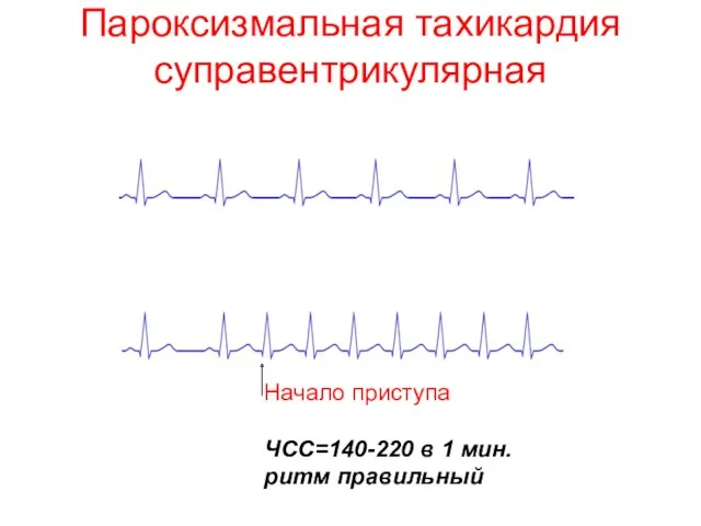 Пароксизмальная тахикардия суправентрикулярная Начало приступа ЧСС=140-220 в 1 мин. ритм правильный