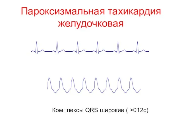 Пароксизмальная тахикардия желудочковая Комплексы QRS широкие ( >012с)